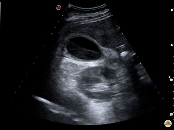 Biliary - Gallbladder with Biliary Sludge