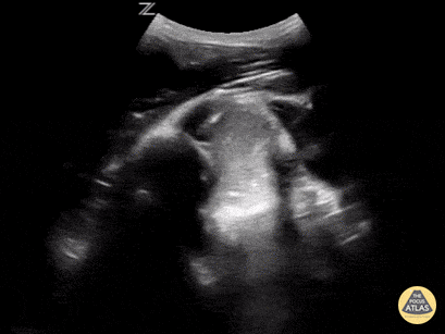 Musculoskeletal - In-Vivo Shoulder Reduction