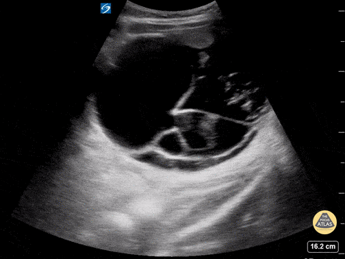 OB/Gyn - Ovarian Teratoma
