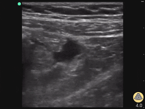 Bowel-GI - Appendicitis