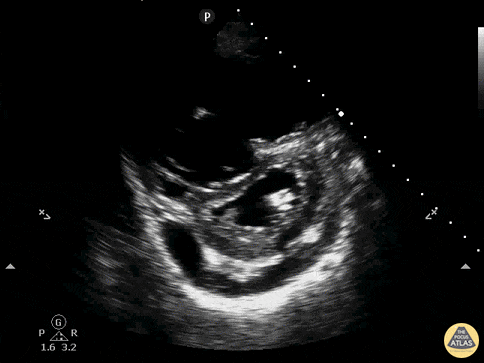 Right Ventricular Dysfunction - D-Sign with RV Dilation, Effusion, PSSA