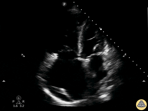 Right Ventricular Dysfunction - RV Dilation, Effusion, A4C