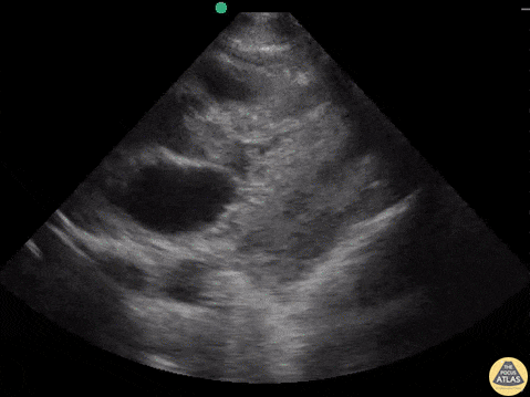 Cardiac Tumors - Squamous Cell Metastases to the Heart