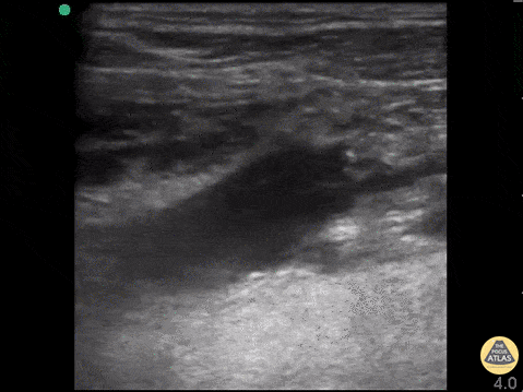 Vascular - Lemierre Syndrome