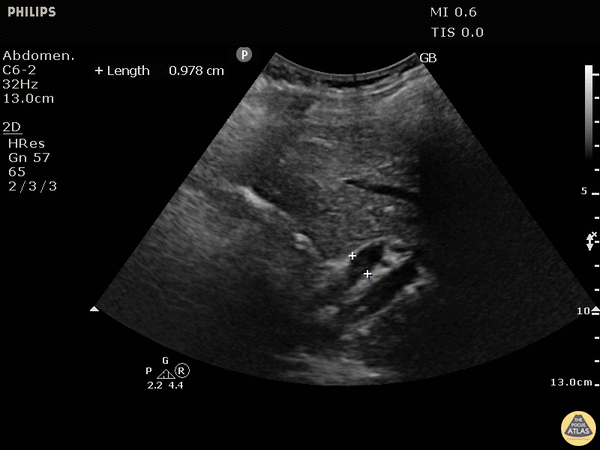 Biliary - Dilated Common Bile Duct