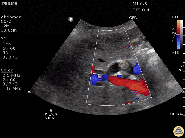 Biliary - Choledocholithiasis - Dilated Common Bile Duct with Stone