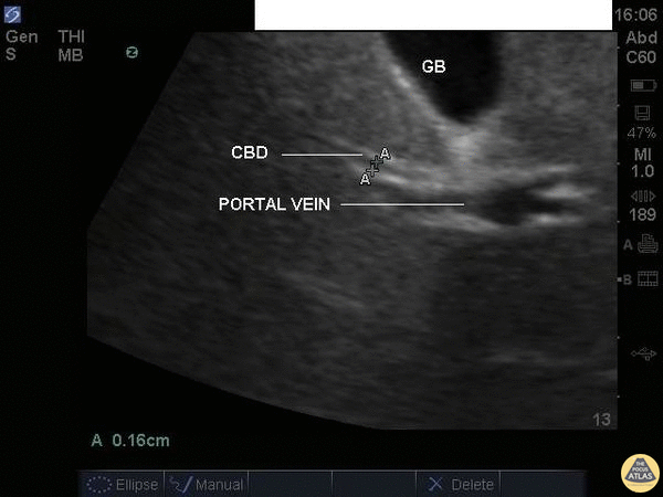 Biliary - Common Bile Duct (Normal Labeled)