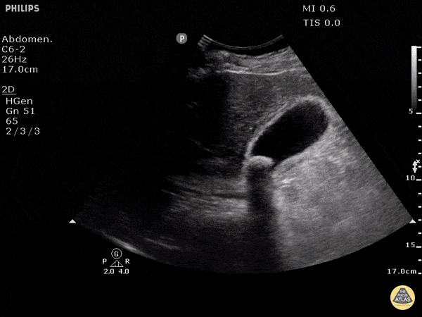 Biliary - Cholecystitis with Obstructing Stone