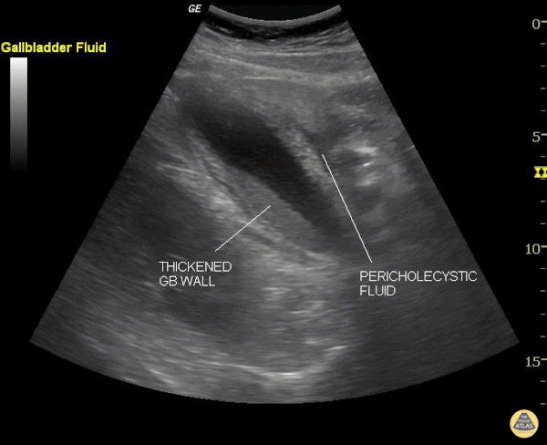 Biliary - Cholecystitis