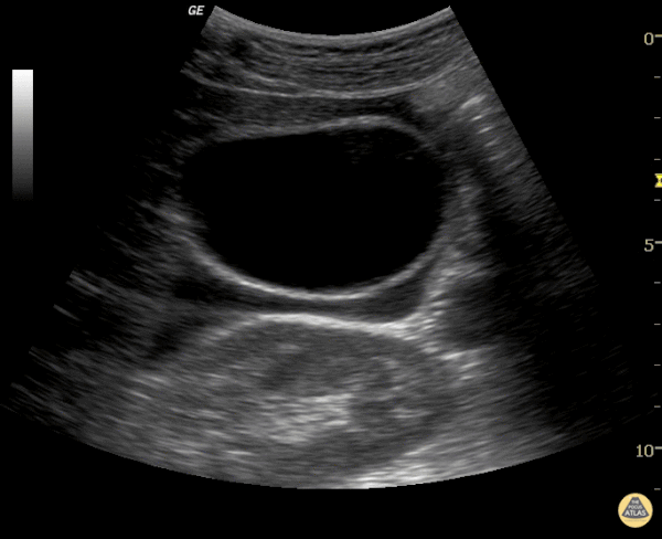 Biliary - Free Fluid around Normal Gallbladder