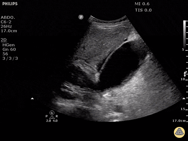Biliary - Pericholecystic Fluid