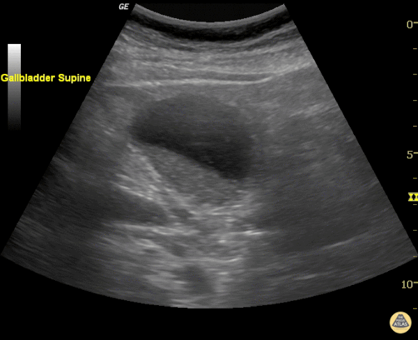 Biliary - Gallbladder Sludge