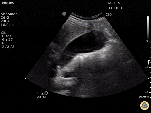 Biliary - Cholelithiasis with Many Stones
