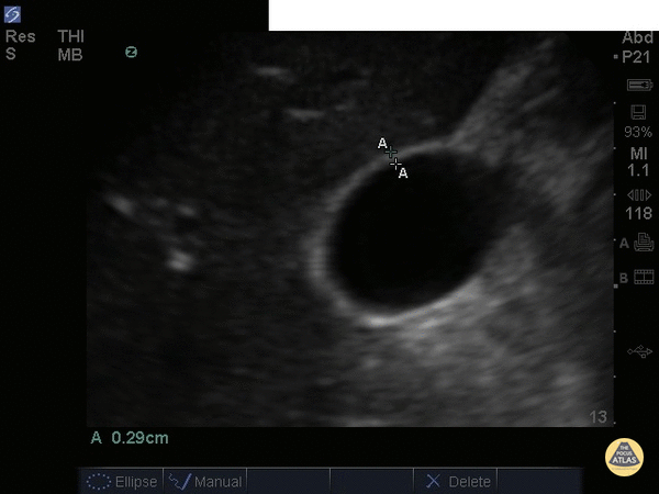 Biliary - Gallbladder Wall Measurement