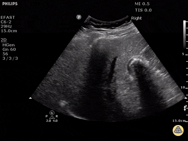 Biliary - Gallbladder Wall Echo Shadow (WES Sign)