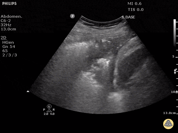 Pulmonary - Compression Atelectasis