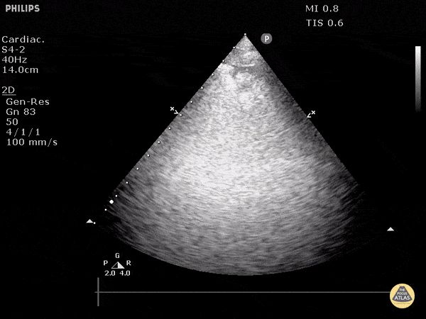 Pulmonary - Pulmonary Embolism (Sector Probe)