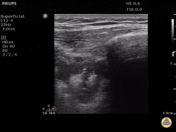 Pulmonary - Pulmonary Embolism (B mode)