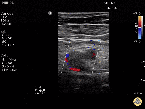 Vascular - DVT of Left Common Femoral Vein