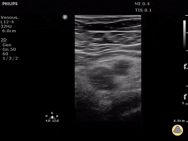 Vascular - DVT Left Common Femoral Vein