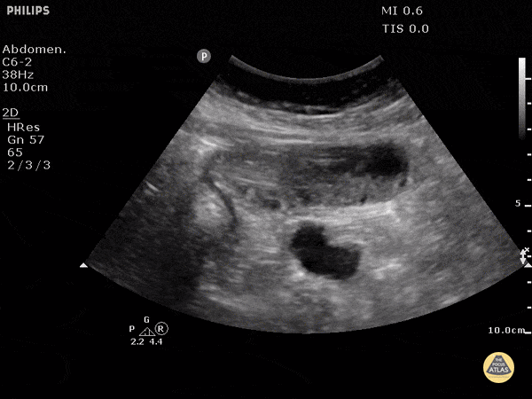 Bowel-GI - Small Bowel Obstruction