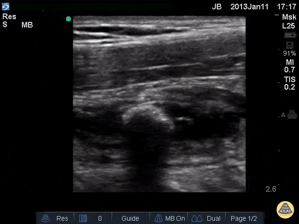 Bowel-GI - Enlarged Appendix with Appendicolith