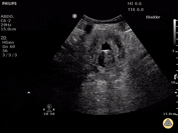 Renal/GU - Bladder Contracted with Indwelling Catheter