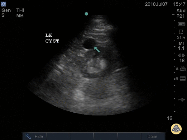 Renal/GU - Left Renal Cyst