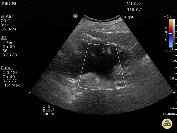 Renal/GU - Severe Hydronephrosis