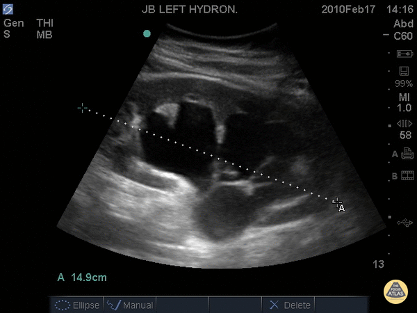 Renal/GU - Severe Hydronephrosis