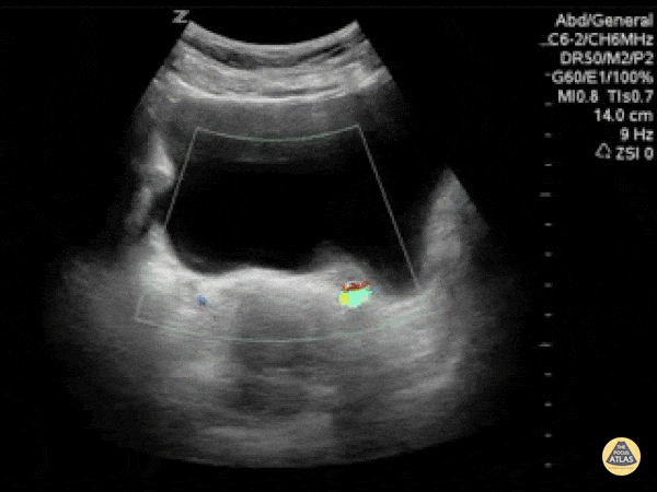 Renal/GU - Ureterovesical Junction Stone Twinkle Artifact