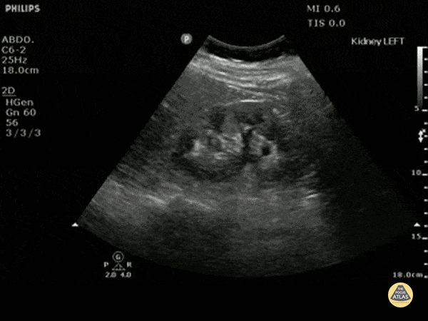 Renal/GU - Moderate Hydronephrosis