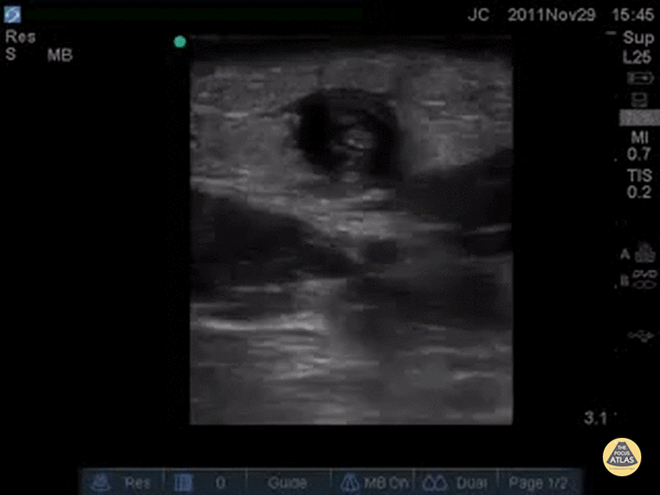 Vascular - Cephalic Vein Thrombophlebitis