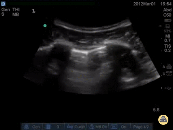 Pulmonary - Pneumothorax Lung Point
