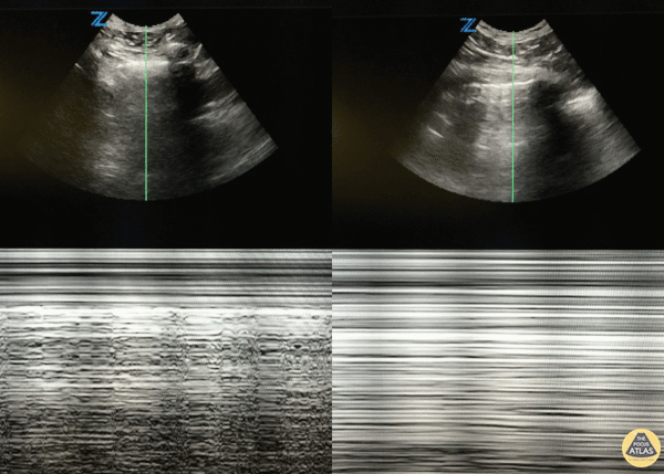 Pulmonary - Pneumothorax: M-mode: Seashore vs Barcode