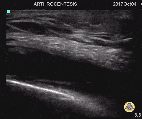Musculoskeletal - Arthrocentesis and Joint Injection