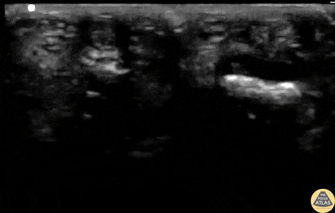 Musculoskeletal - Flexortenosynovitis (FTS)