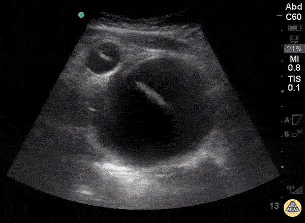 Renal/GU - Difficult Foley: Bladder Diverticulum