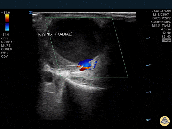 Vascular - Pseudoaneurysm - Radial Artery