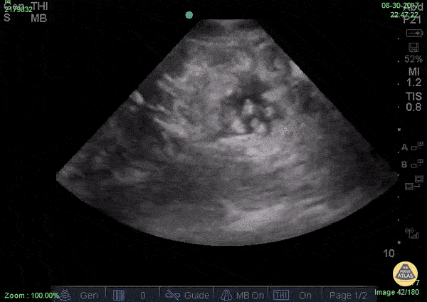 Bowel-GI - Ascites... hello?