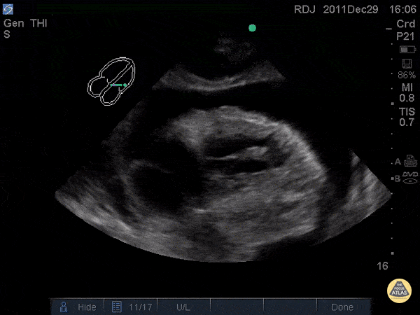 Pericardial Disease - Chronic Pericardial Effusion