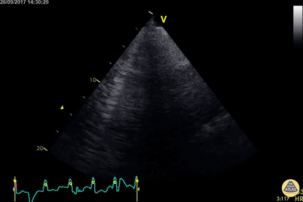 Pulmonary - Confluent B Lines