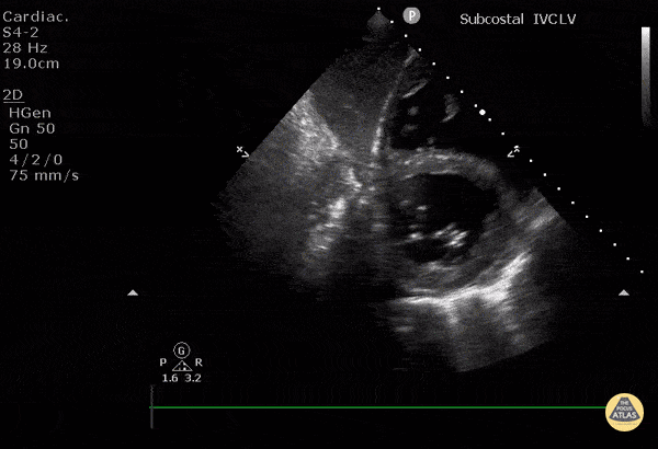 Normal Cardiac Anatomy - Subcostal Short Axis