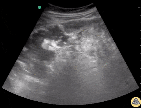 Bowel-GI - Perforated Appendicitis