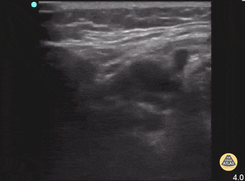 Soft Tissue - Sialadenitis (Postoperative)