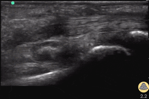 Musculoskeletal - Flexor Tendons of Hand (normal)