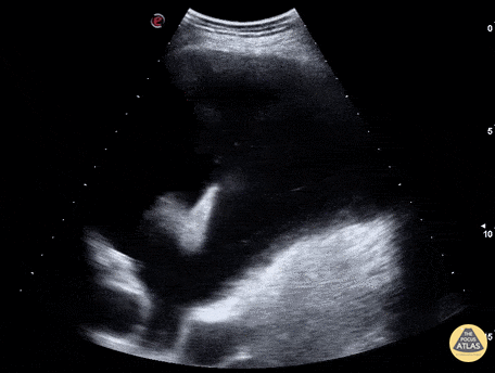 Pulmonary - Dove in Pleural Fluid
