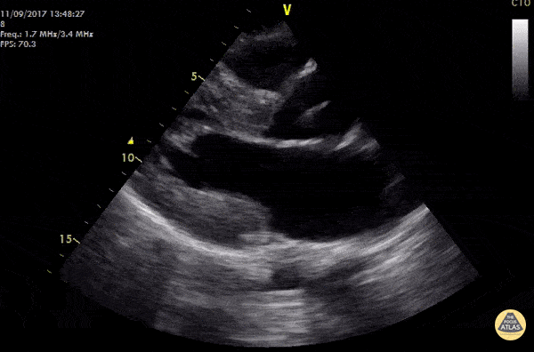 Valvulopathy - Hypertrophic Obstructive Cardiomyopathy