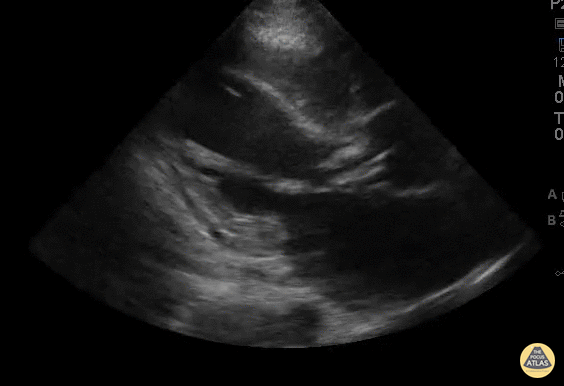 Valvulopathy - Aortic & Mitral Valve Vegetations