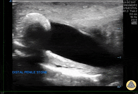 Renal/GU - Penile Urethral Calculus